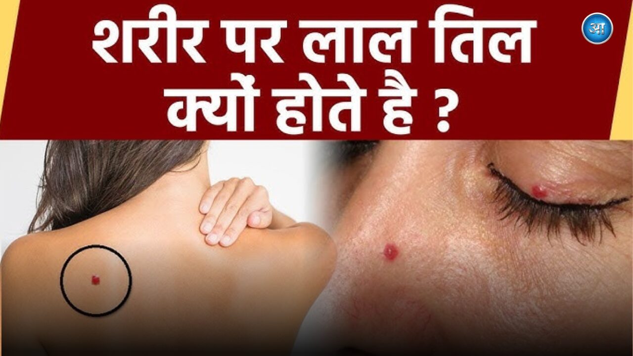 Moles on human skin showing different sizes and colors explaining causes and health risks